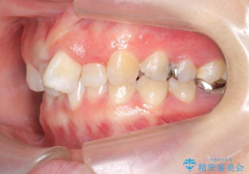 ねじれた前歯を改善するマウスピース矯正の治療前