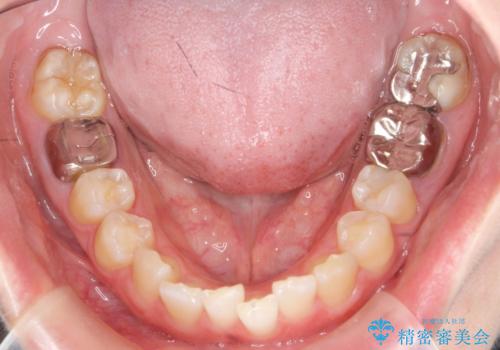 ねじれた前歯を改善するマウスピース矯正の治療前