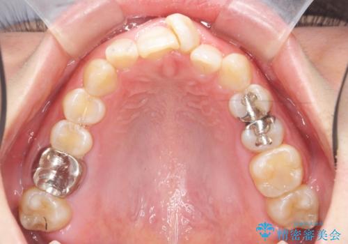 ねじれた前歯を改善するマウスピース矯正の治療前