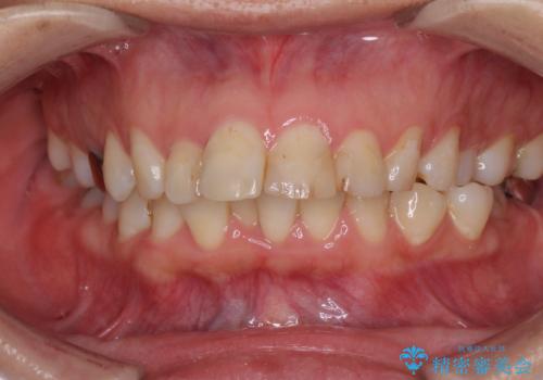 ハーフリンガルで歯列をきれいに　セラミック治療で気になる銀歯も自然な色にの症例 治療前