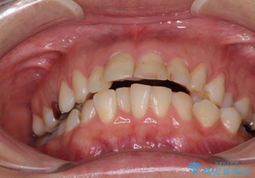 ハーフリンガルで歯列をきれいに セラミック治療で気になる銀歯も自然な色にの治療前