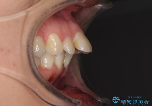 ハーフリンガルで歯列をきれいに セラミック治療で気になる銀歯も自然な色にの治療前