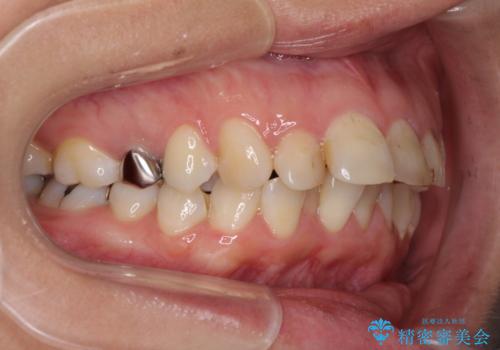 ハーフリンガルで歯列をきれいに セラミック治療で気になる銀歯も自然な色にの治療前