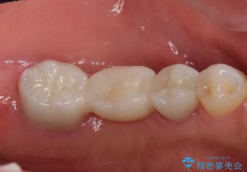 奥歯の高さがない 20代で入れ歯もインプラントも難しい ブリッジで歯を残す治療の治療後