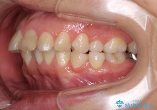 ハーフリンガルで歯列をきれいに セラミック治療で気になる銀歯も自然な色にの治療前