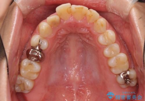 ハーフリンガルで歯列をきれいに セラミック治療で気になる銀歯も自然な色にの治療前