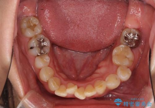 ハーフリンガルで歯列をきれいに　セラミック治療で気になる銀歯も自然な色にの治療前