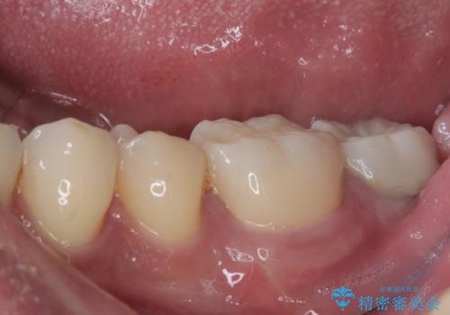 銀歯の周りから進行したむし歯　欠けてしまった歯をオールセラミッククラウンにの治療後