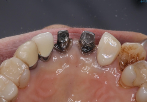 前歯のセラミック 神経の再治療からの治療中