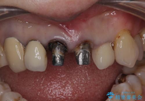 前歯のセラミック 神経の再治療からの治療中