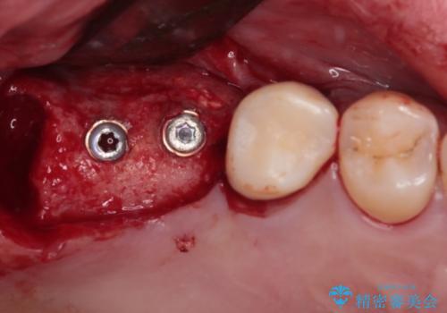 奥歯の欠損部　インプラント補綴治療の治療中