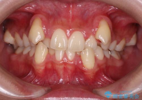 【抜歯矯正】犬歯抜歯による矯正。八重歯を治したいの症例 治療前