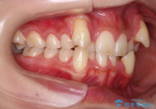 【抜歯矯正】犬歯抜歯による矯正。八重歯を治したいの治療前