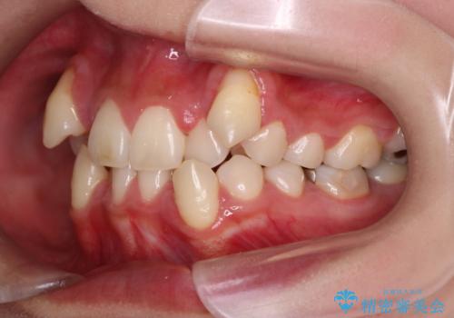 【抜歯矯正】犬歯抜歯による矯正。八重歯を治したい。の治療前