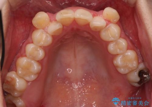 【抜歯矯正】犬歯抜歯による矯正。八重歯を治したいの治療前