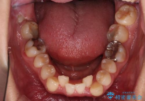 【抜歯矯正】犬歯抜歯による矯正。八重歯を治したい。の治療前