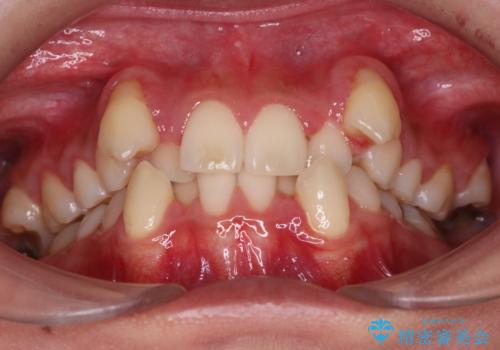 【抜歯矯正】犬歯抜歯による矯正。八重歯を治したいの治療前