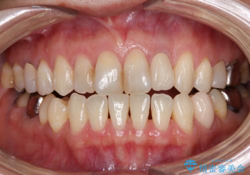 根元がうずく前歯 根管治療とオールセラミック治療の治療後