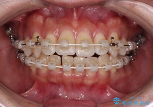 気になる八重歯 ワイヤー装置での非抜歯矯正の治療中