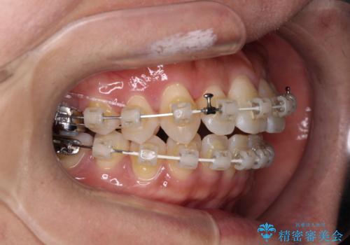 気になる八重歯　ワイヤー装置での非抜歯矯正の治療中