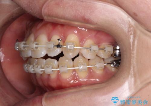 気になる八重歯　ワイヤー装置での非抜歯矯正の治療中