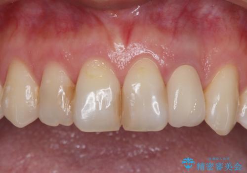 根元がうずく前歯 根管治療とオールセラミック治療の治療後