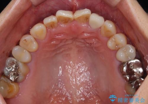 根元がうずく前歯 根管治療とオールセラミック治療の治療後