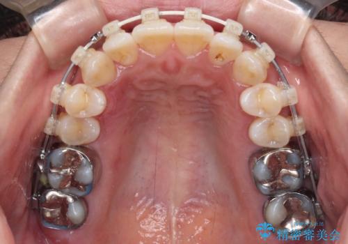 気になる八重歯 ワイヤー装置での非抜歯矯正の治療中