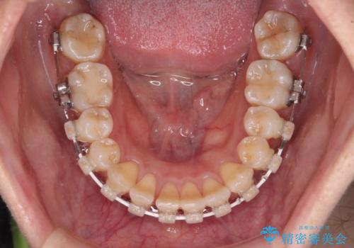 気になる八重歯 ワイヤー装置での非抜歯矯正の治療中