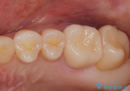 [歯と歯の間の虫歯] ジルコニアクラウンの症例 治療後