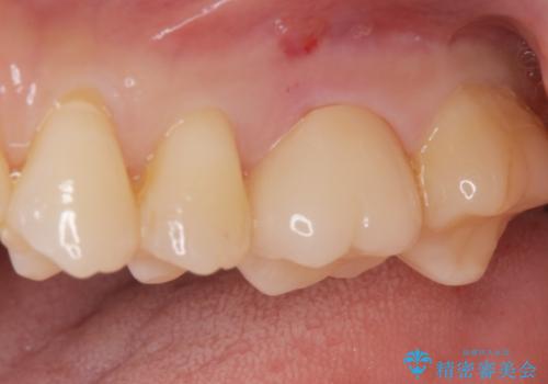 [歯と歯の間の虫歯] ジルコニアクラウンの治療後
