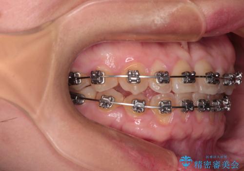 反対咬合を治したい ワイヤー装置で一気に咬み合わせを改善の治療中