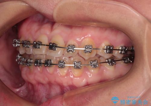反対咬合を治したい ワイヤー装置で一気に咬み合わせを改善の治療中