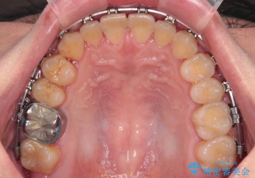 反対咬合を治したい ワイヤー装置で一気に咬み合わせを改善の治療中