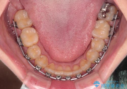 反対咬合を治したい ワイヤー装置で一気に咬み合わせを改善の治療中