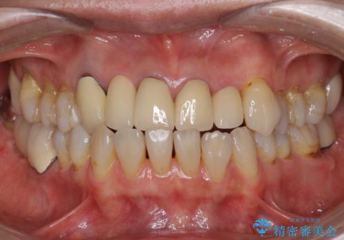 前歯のセラミック 神経の再治療からの治療後