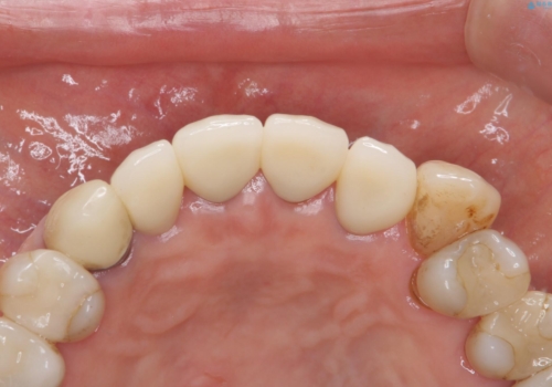 前歯のセラミック 神経の再治療からの治療後