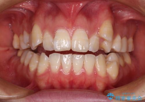 八重歯と開咬の抜歯矯正　ワイヤー装置を併用したインビザライン矯正治療の症例 治療前