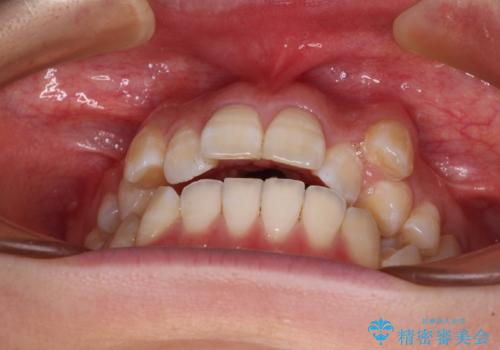 八重歯と開咬の抜歯矯正 ワイヤー装置を併用したインビザライン矯正治療の治療前