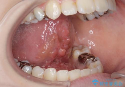 舌が動かしにくいから舌小帯を切りたいの治療後