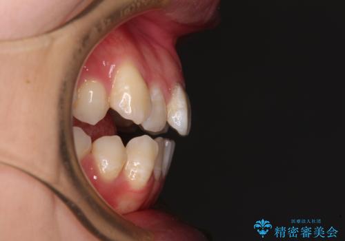 八重歯と開咬の抜歯矯正 ワイヤー装置を併用したインビザライン矯正治療の治療前