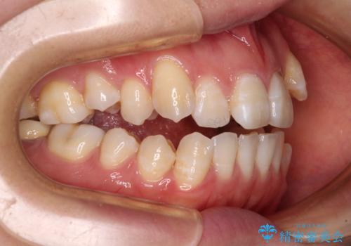 八重歯と開咬の抜歯矯正　ワイヤー装置を併用したインビザライン矯正治療の治療前