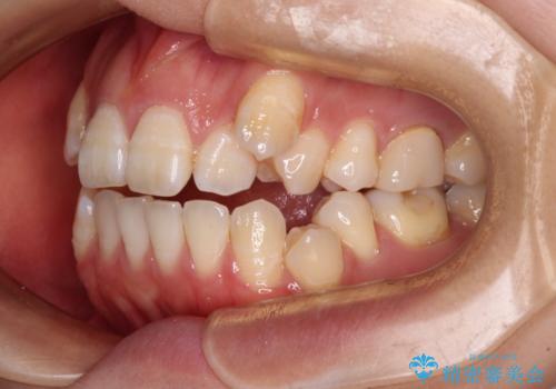 八重歯と開咬の抜歯矯正 ワイヤー装置を併用したインビザライン矯正治療の治療前