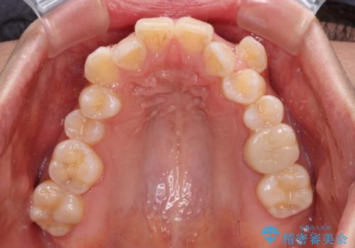 八重歯と開咬の抜歯矯正 ワイヤー装置を併用したインビザライン矯正治療の治療前