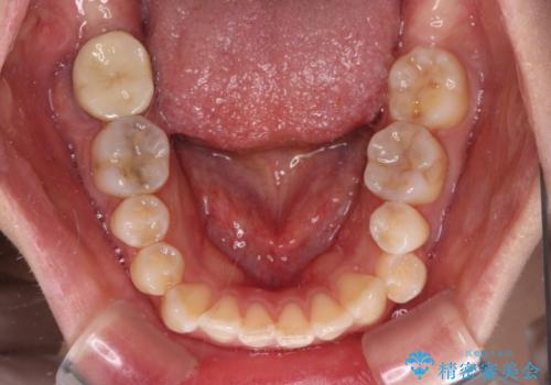 八重歯と開咬の抜歯矯正 ワイヤー装置を併用したインビザライン矯正治療の治療前