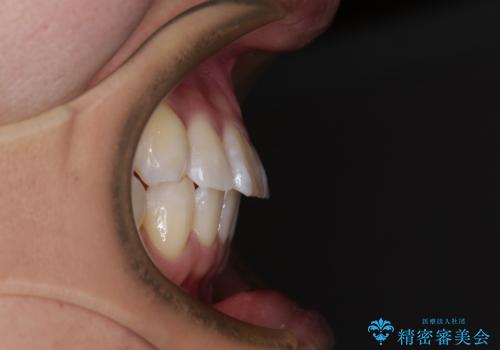 【モニター】動きにくい歯と乱れた咬合平面　アンカースクリューで咬合改善の治療後