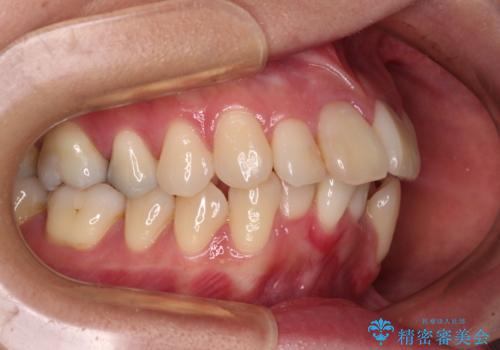 気になる出っ歯を治したい 抜歯矯正でスッキリした横顔にの治療前