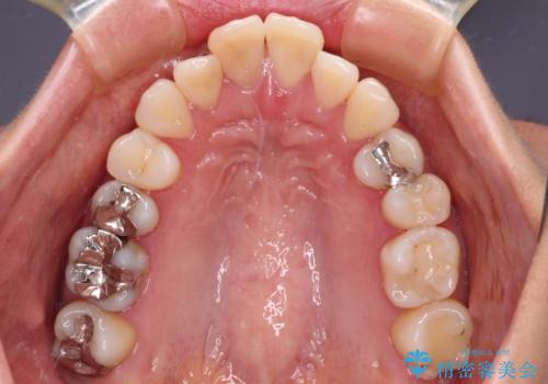 気になる出っ歯を治したい 抜歯矯正でスッキリした横顔にの治療前