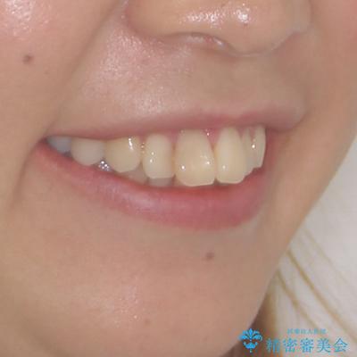気になる出っ歯を治したい　抜歯矯正でスッキリした横顔にの治療前（顔貌）