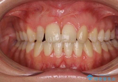 矮小歯と欠損によるずれた位置の大きな歯 オールセラミッククラウンで自然にの治療前